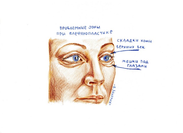 "УСТАЛЫЙ ВЗГЛЯД" У ПАЦИЕНТКИ С КОЖНЫМИ СКЛАДКАМИ И ГРЫЖАМИ ВЕК "УСТАЛЫЙ ВЗГЛЯД" У ПАЦИЕНТКИ С КОЖНЫМИ СКЛАДКАМИ И ГРЫЖАМИ ВЕК