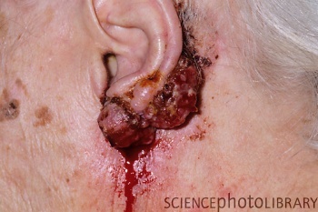 Рак кожи уха