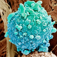 Клетка рака кожи в режиме электронной микроскопии