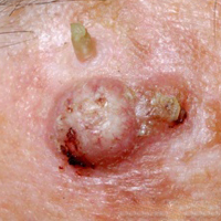 Базальноклеточный рак кожи